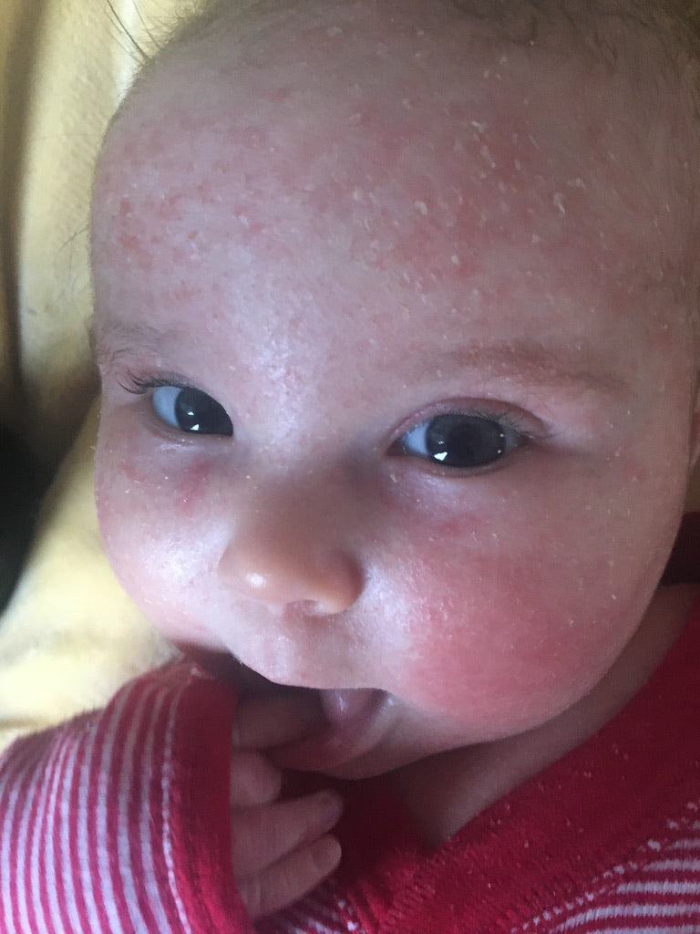 Why Does Eczema Happen?