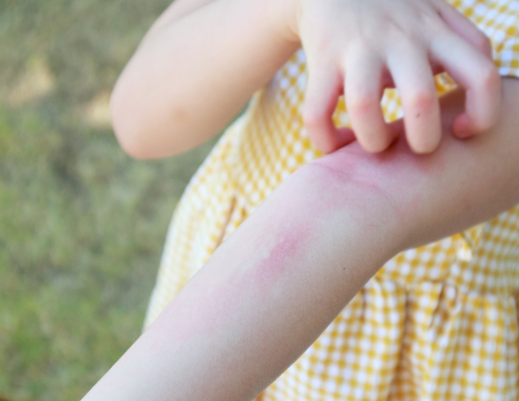 Vitamins Targeting Eczema Itch