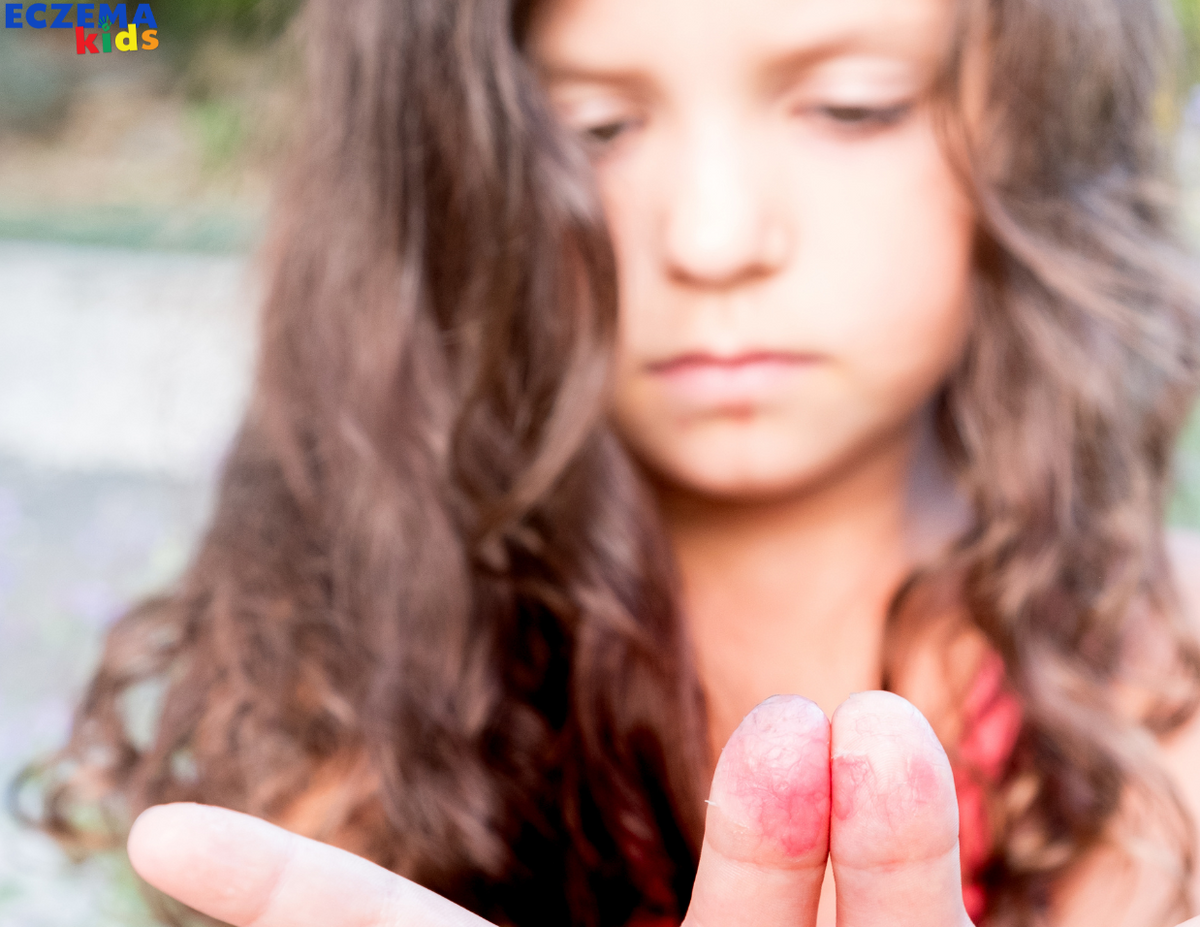 Why is My Child's Eczema Getting Worse?