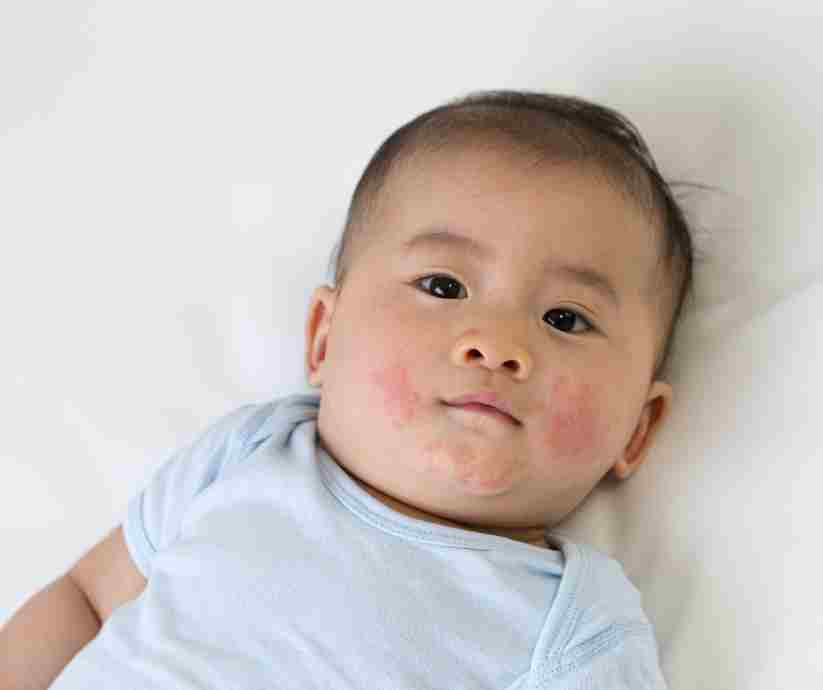How to Identify Eczema Triggers