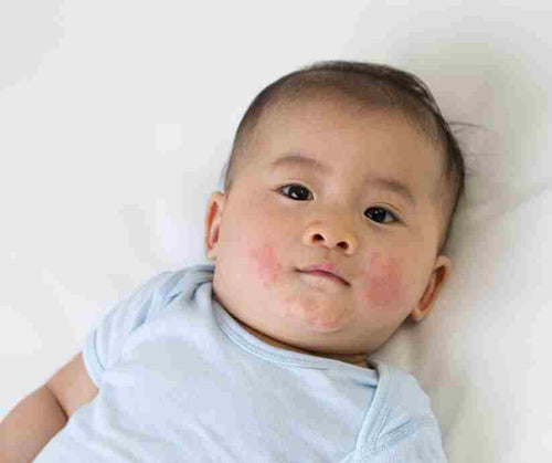 How to Identify Eczema Triggers