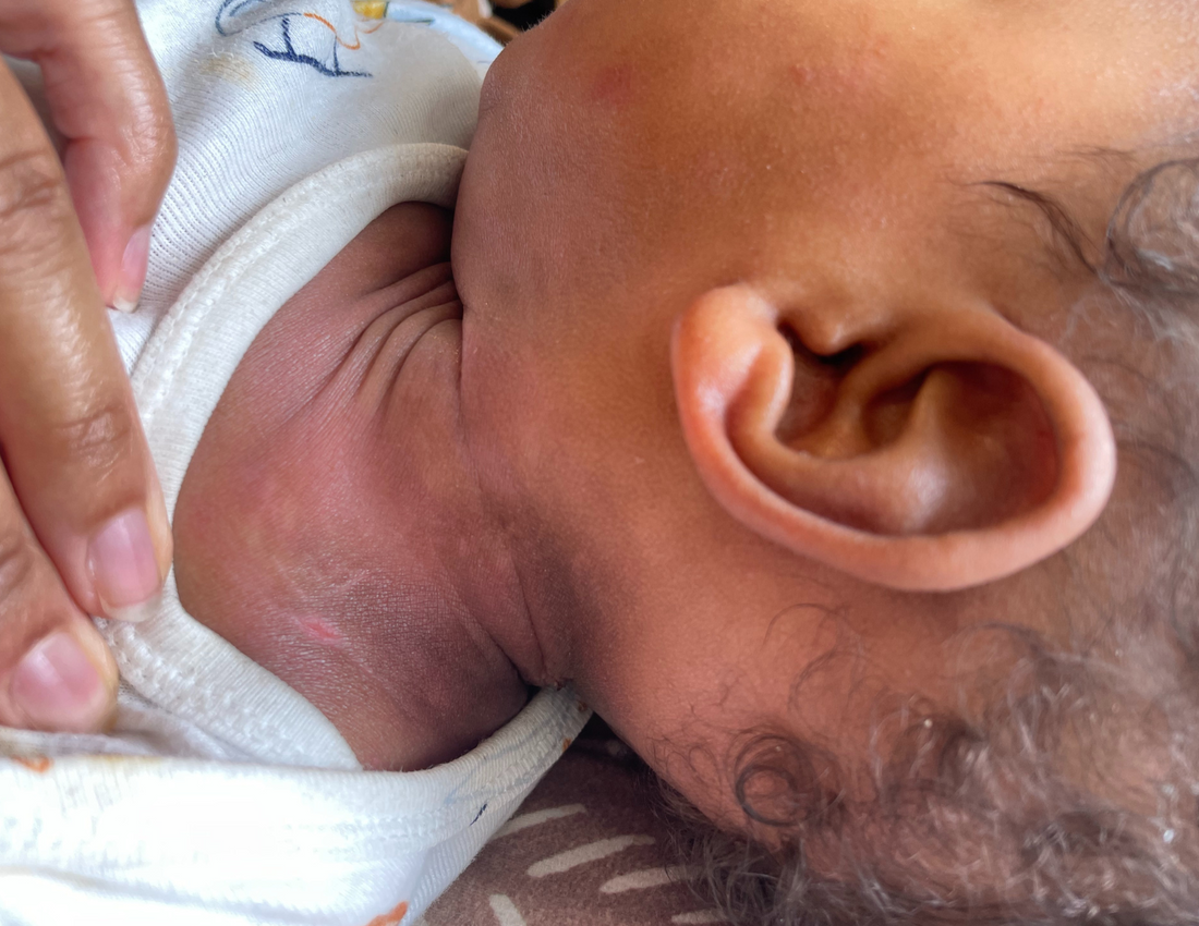 Your 5-Day Rescue Plan for a Summer Eczema Flare - eczemakids.com