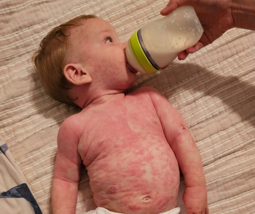Why Natural Eczema Treatments Aren’t Working - eczemakids.com