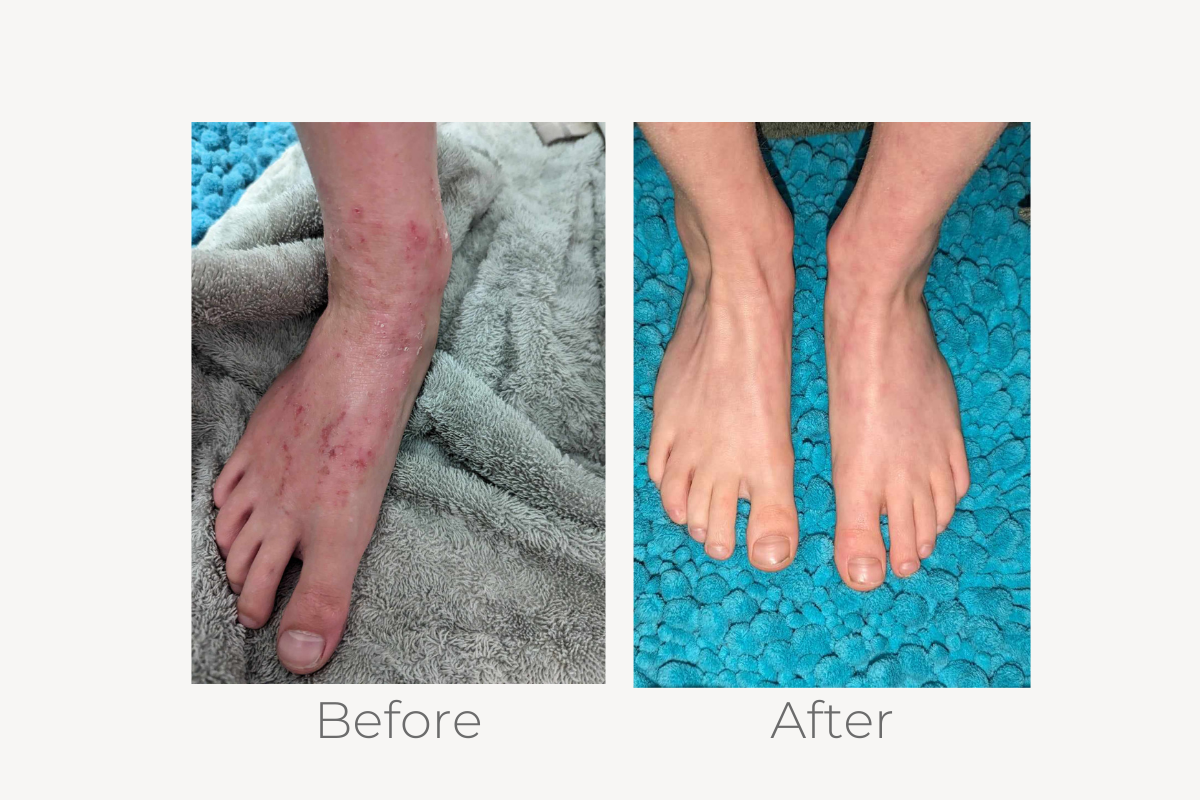 natural eczema treatment