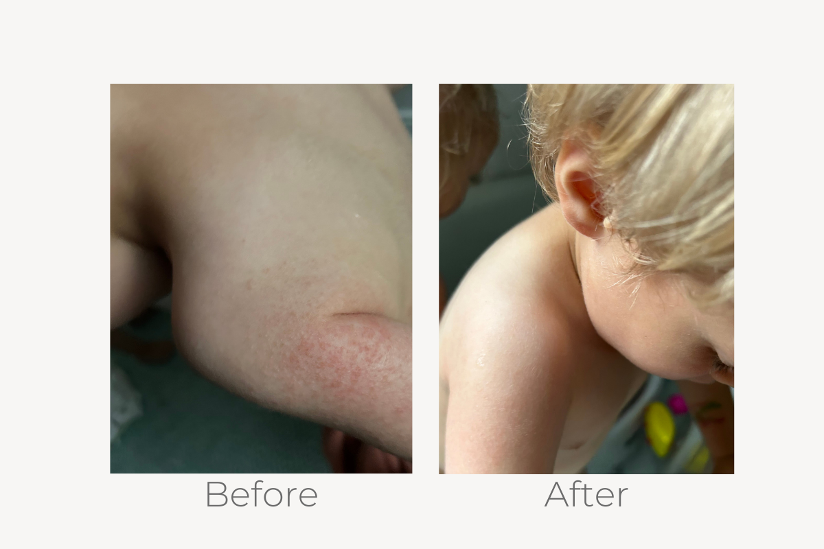 natural eczema treatment