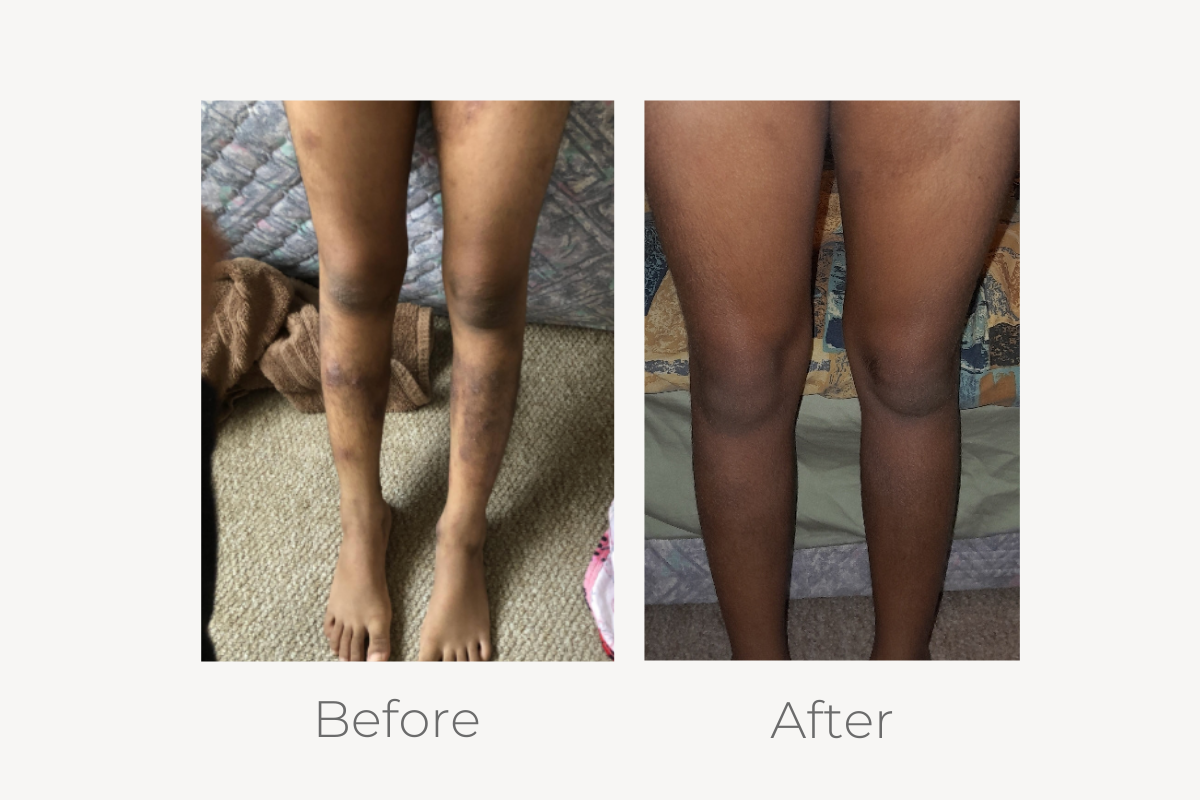 natural eczema treatment