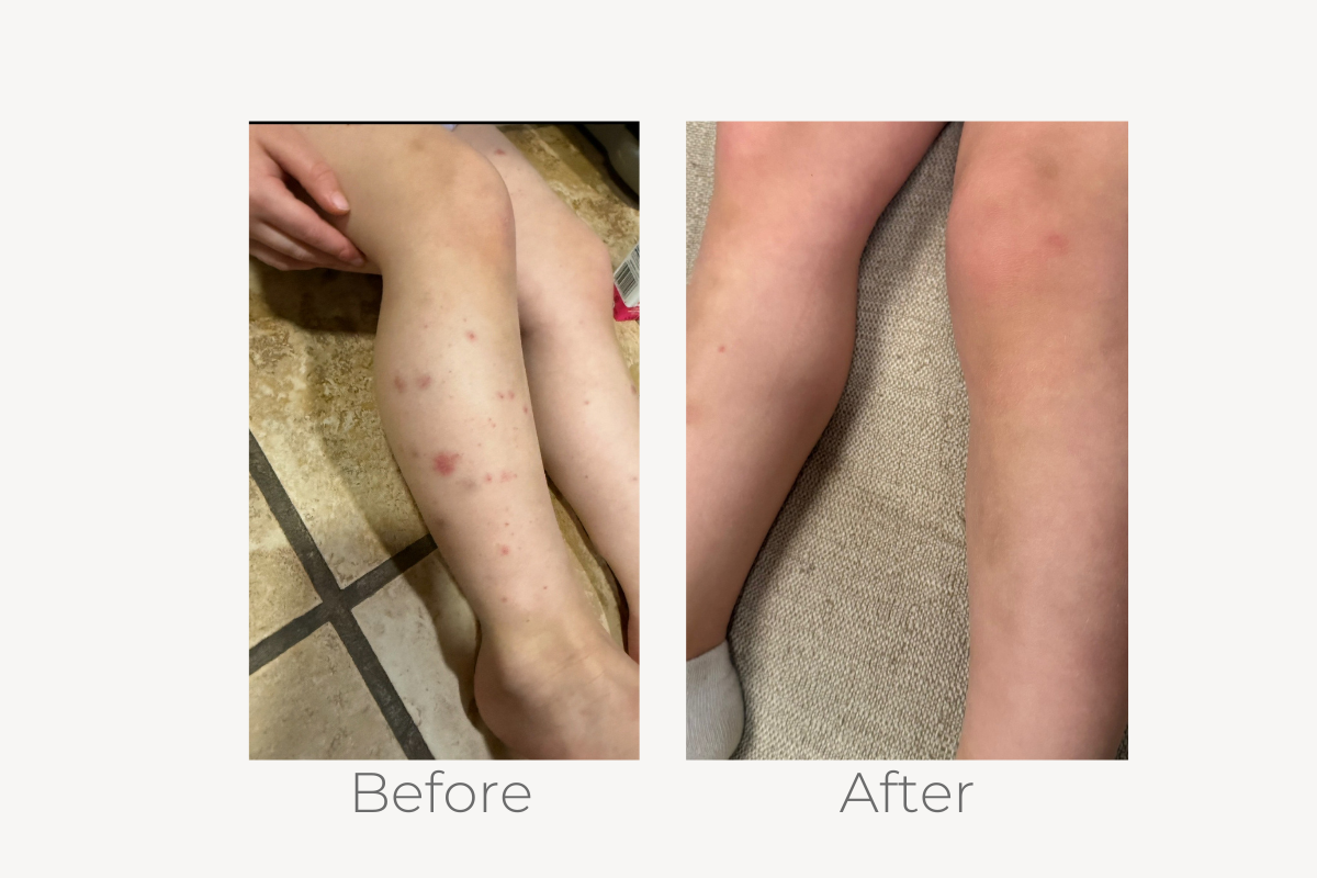 natural eczema treatment