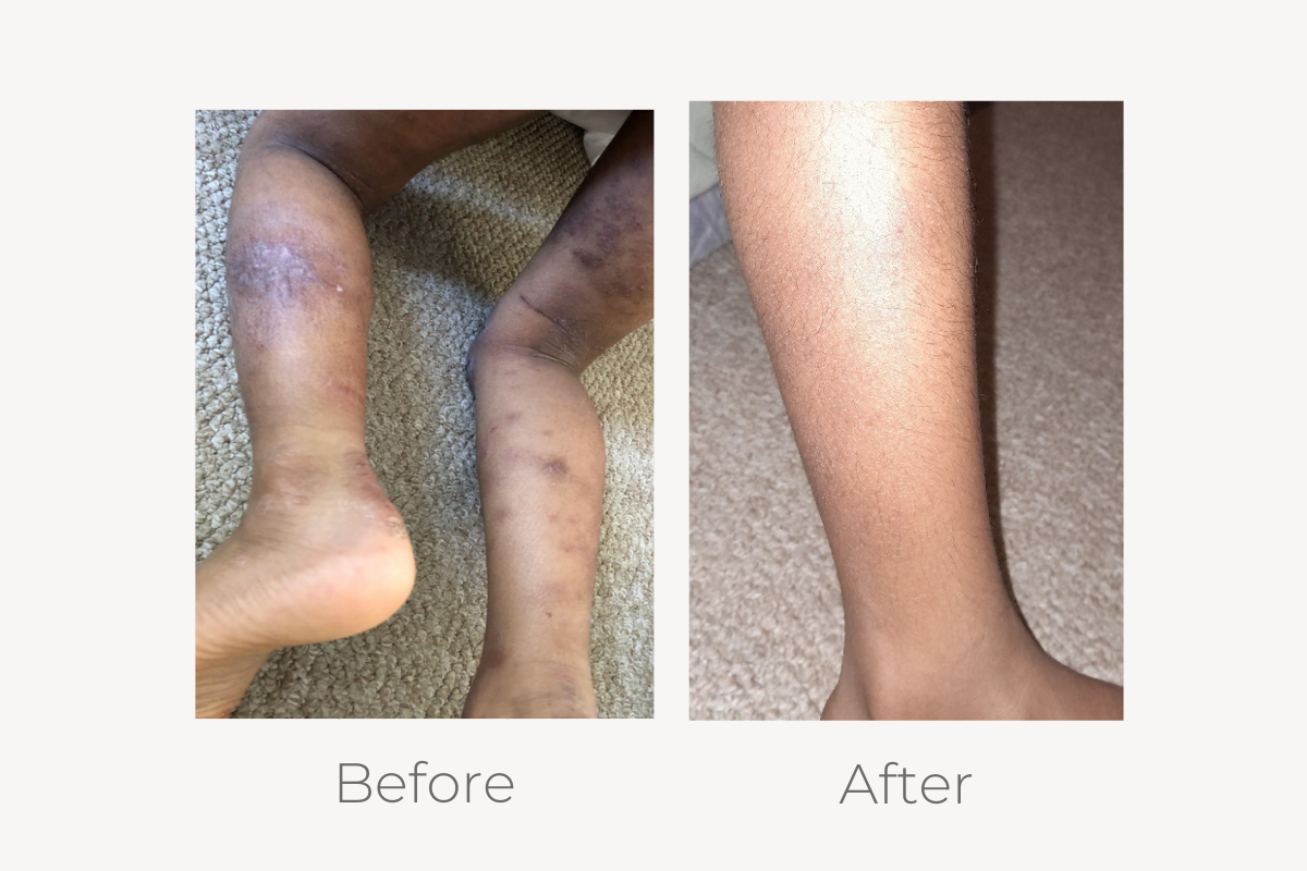 natural eczema treatment