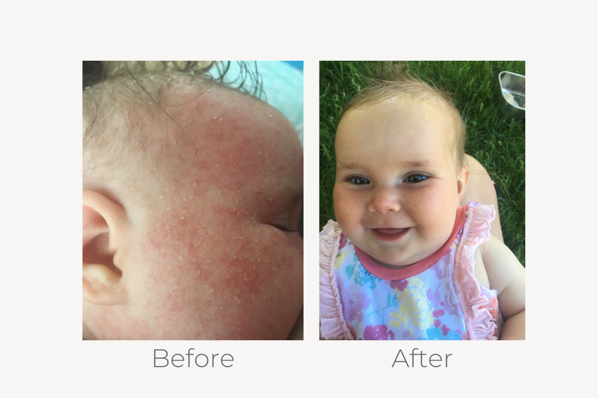 natural eczema treatment