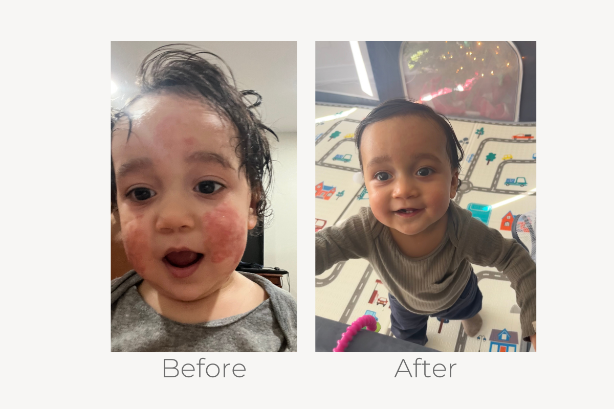 natural eczema solutions