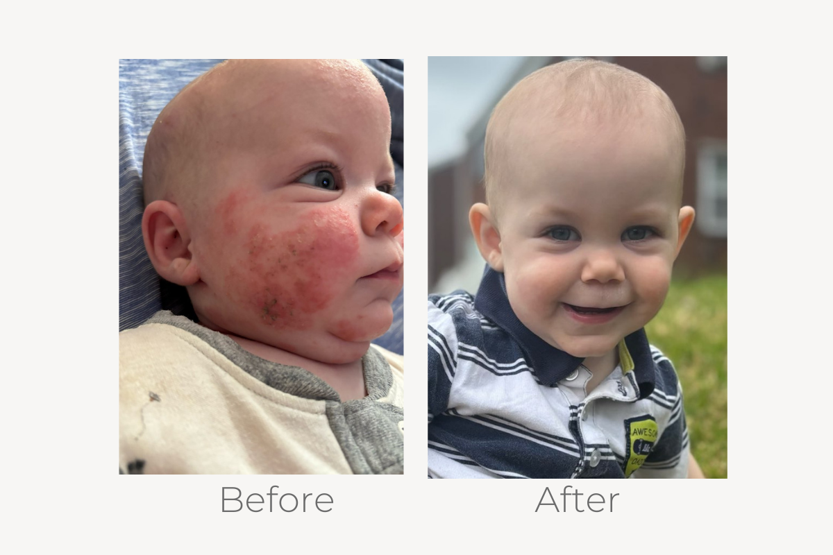 natural eczema treatment
