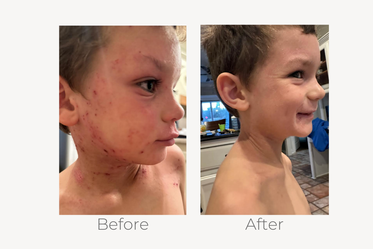 natural eczema treatment