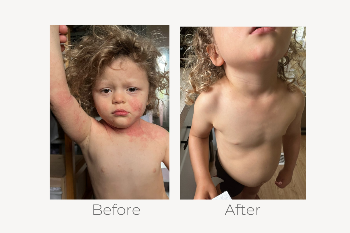 natural eczema treatment