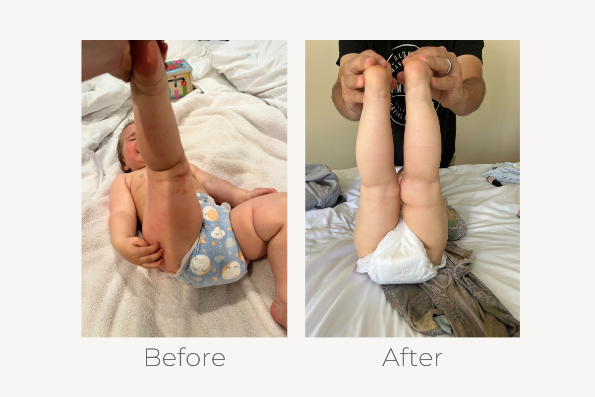 natural eczema treatment