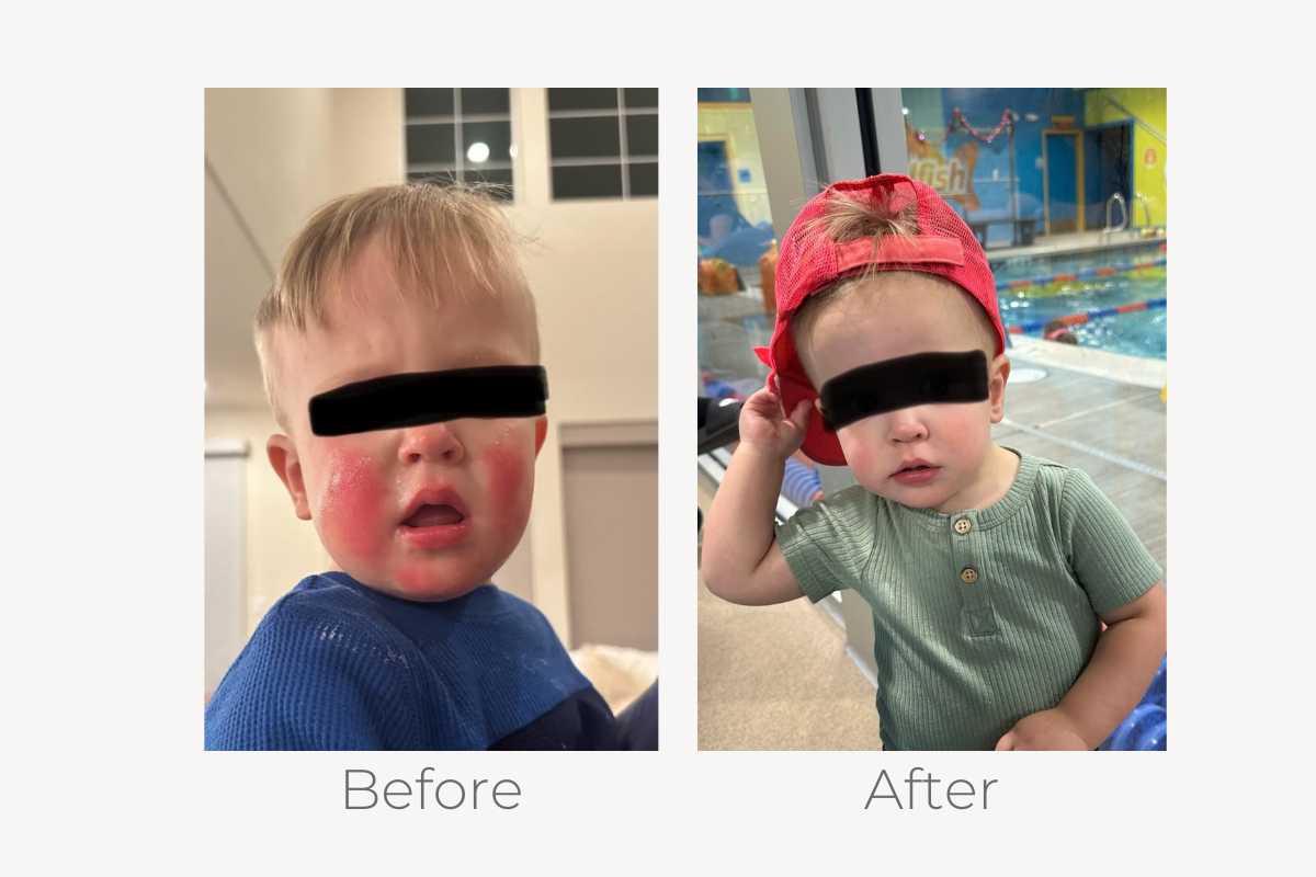 natural eczema treatment