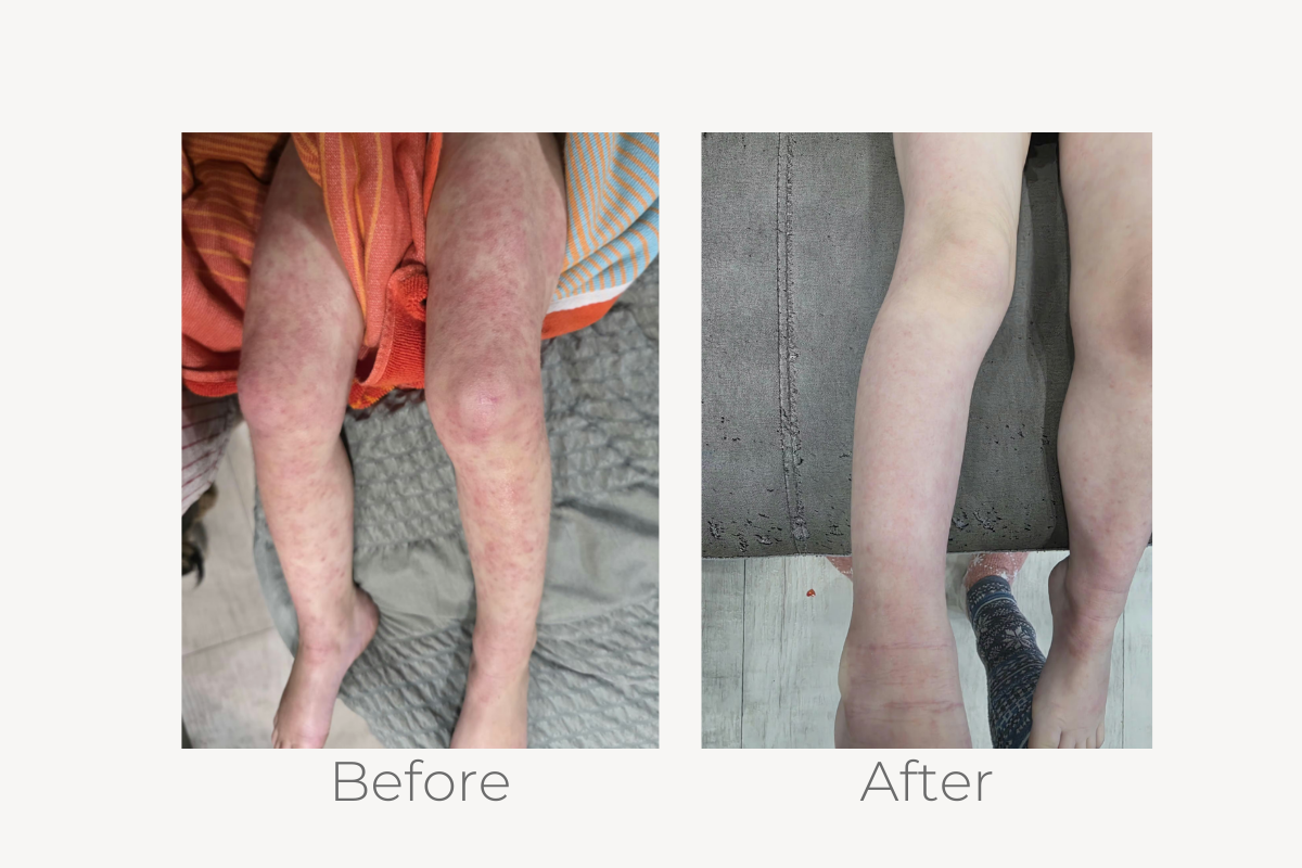 natural eczema treatment