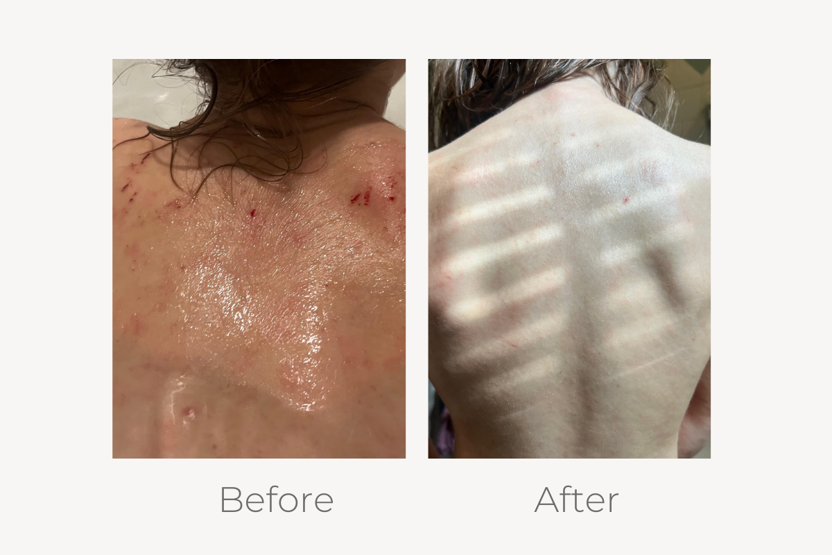 natural eczema treatment