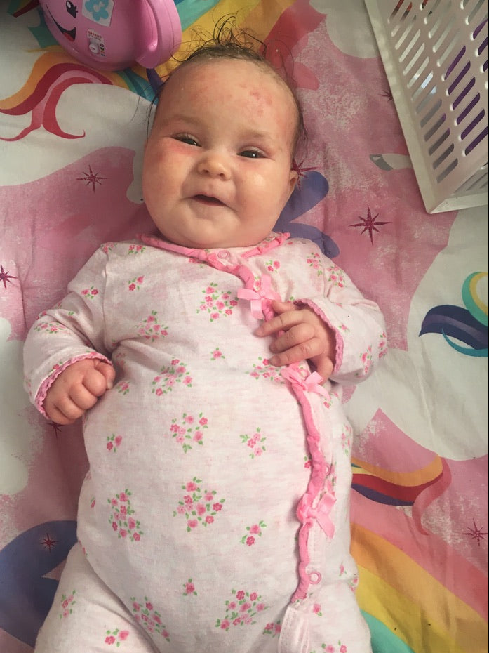 baby eczema